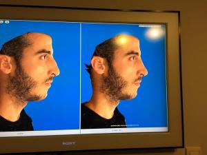 00a.8months post-op Rhinoplasty Before and After photos 01148
