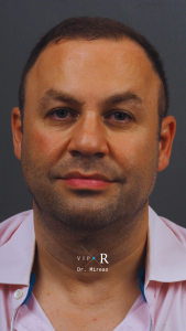 01a. Pre-op Rhinoplasty Before and After photos MP-01671-CP.JPG