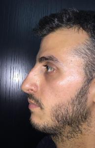 02a. Pre-op Rhinoplasty Before and After photos 01148