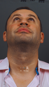 02a. Pre-op Rhinoplasty Before and After photos MP-01671-CP.JPG