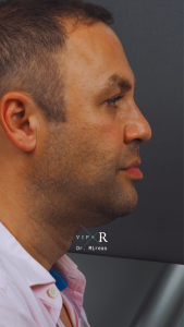 03a. Pre-op Rhinoplasty Before and After photos MP-01671-CP.JPG