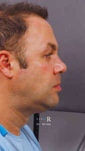 03c. Post-op Rhinoplasty Before and After photos MP-01671-CP