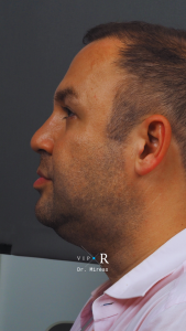 04a. Pre-op Rhinoplasty Before and After photos MP-01671-CP.JPG