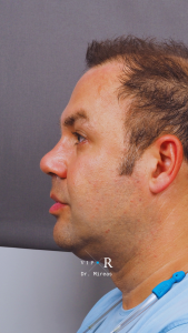 04c. Post-op Rhinoplasty Before and After photos MP-01671-CP